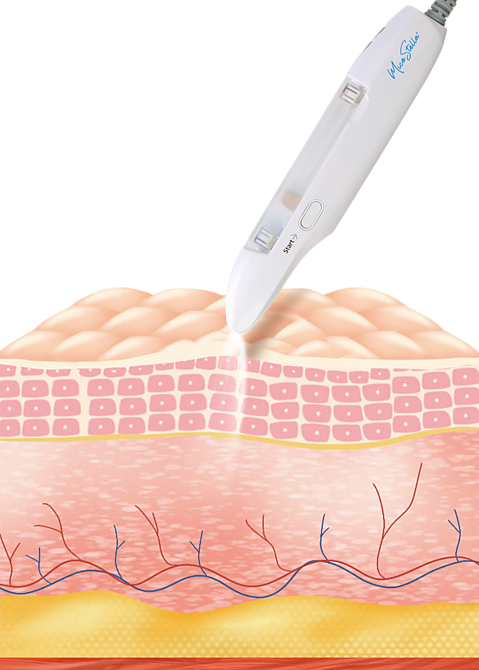 無針水光注射 ミコステラ | エステサロン EverLasting 静岡の毛穴洗浄